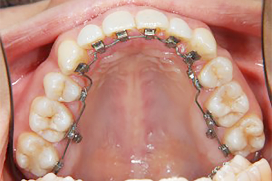 Ｂスマイル歯科矯正歯科の矯正装置