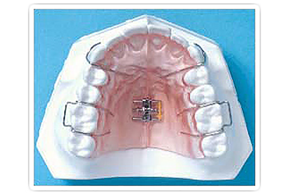 拡大装置（床矯正）取り外し可能なプレートタイプ