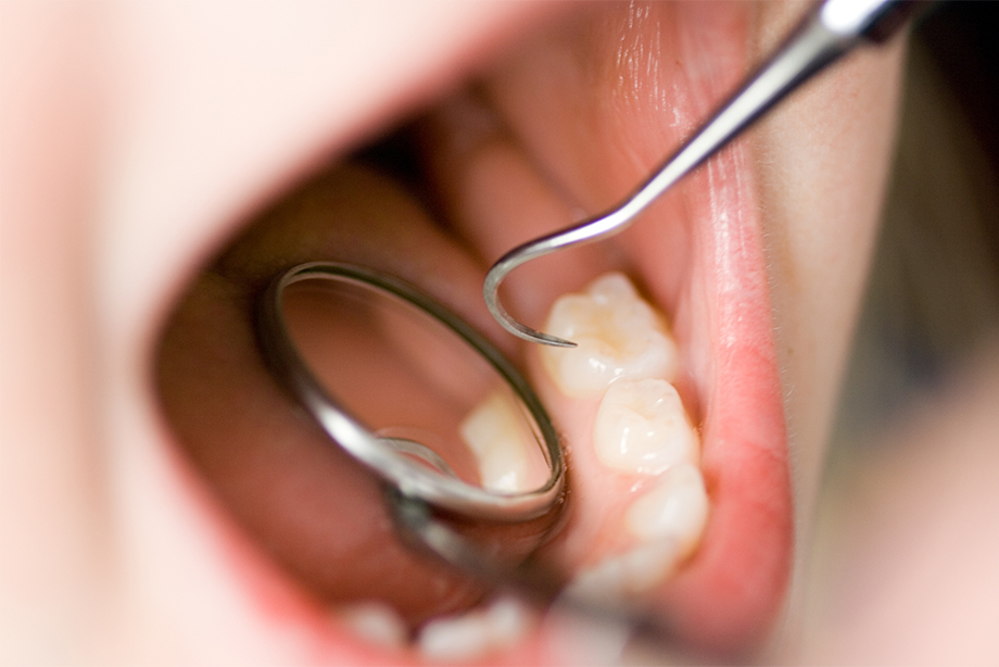 乳歯のむし歯は永久歯にも影響する